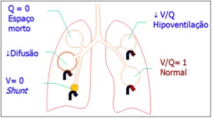 Mecanismos de disfunção da relação ventilação/perfusão no parênquima pulmonar que podem causar hipoxemia e/ou hipercapnia.