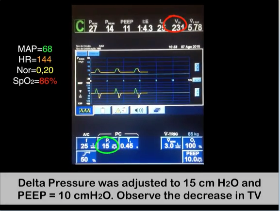 video aula Alveolar Maximum Recruitment Maneuver and Decremental Titration of PEEP in VCV mode