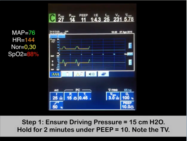 video aula Alveolar Maximum Recruitment Maneuver and Decremental Titration of PEEP in PCV mode